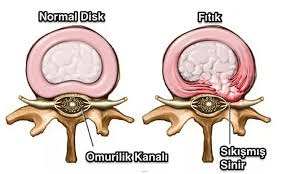 Bel Fıtığı